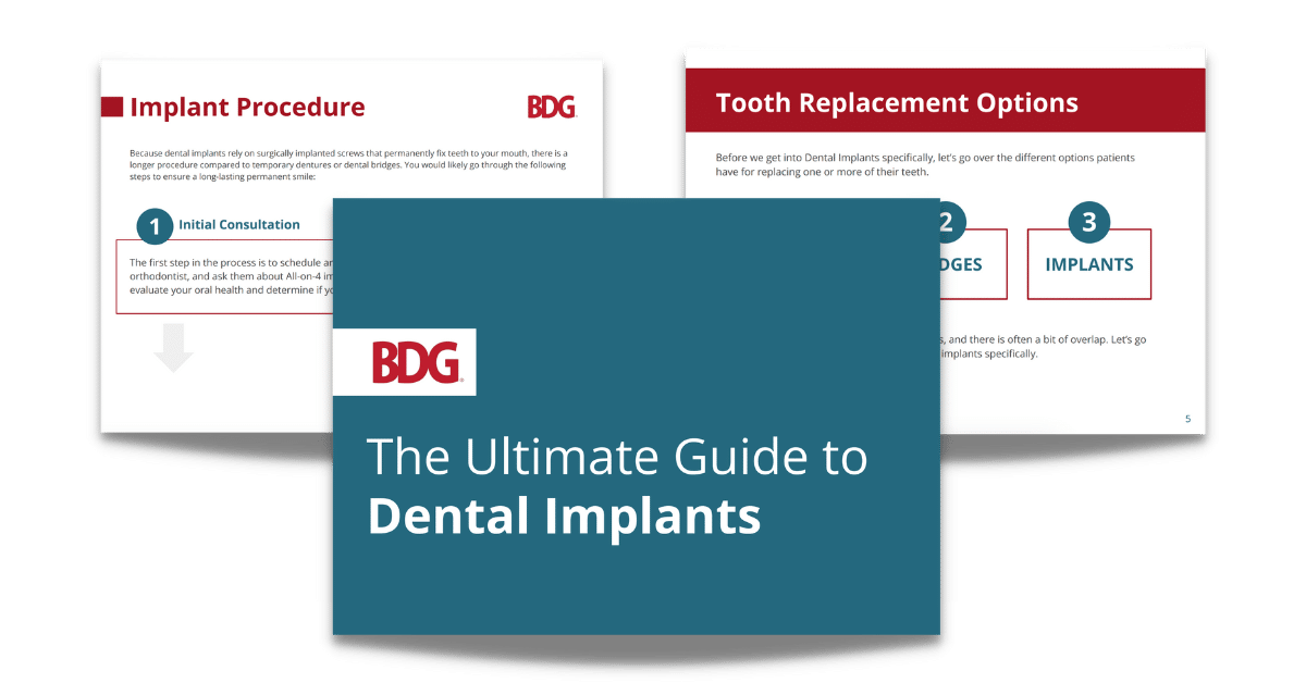 BDG Dental Implants Guide