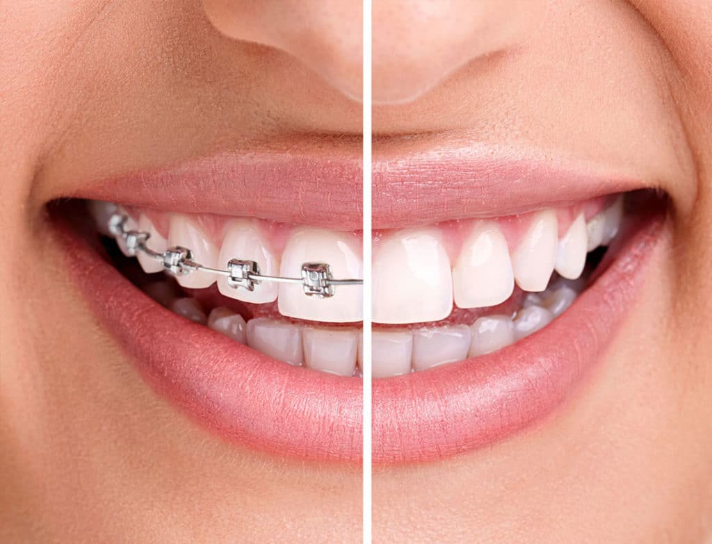 Braces on and braces off with straight teeth side-by-side