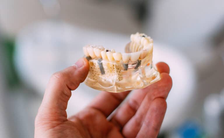 hand holding up a model of the bottom jaw, with dental implants placed using an all on 4 method, with clear gums to highlight the implant placement under the teeth