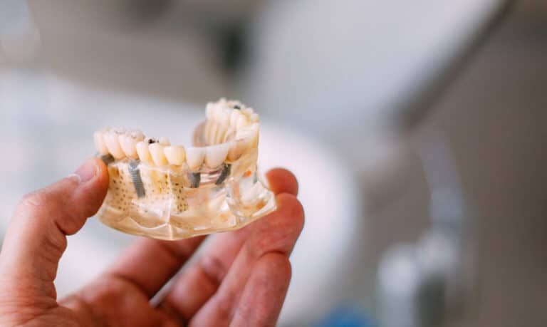 hand holding up a model of the bottom jaw, with dental implants placed using an all on 4 method, with clear gums to highlight the implant placement under the teeth