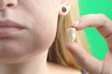 Female patient with a swollen jaw holds up extracted tooth. Emergency Wisdom teeth extraction