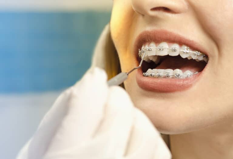 Closeup dental braces checkup , perfect white teeth with dental braces woman in half smile