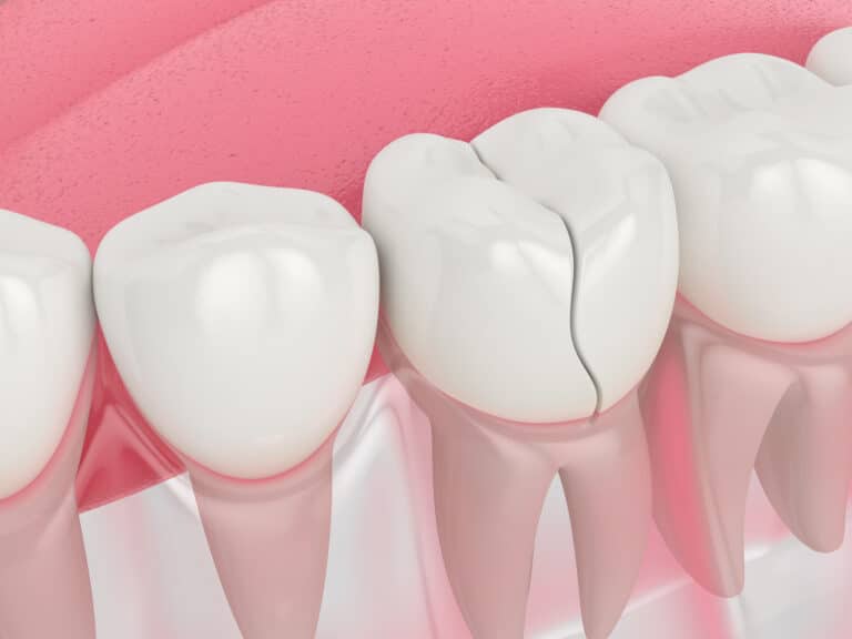 3d render of jaw with treatable cracked tooth over white background. Types of broken teeth concept. Cracked tooth syndrome