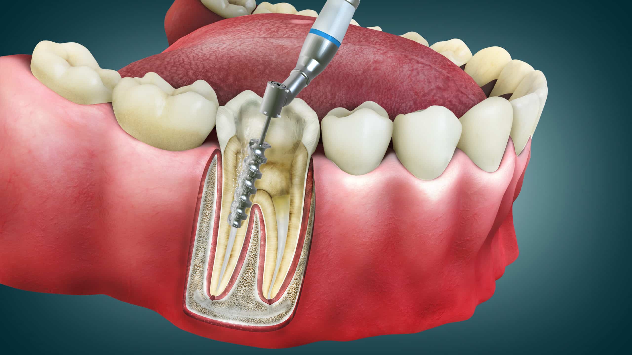 4D Root Canal Image showing a dental drill cleaning the tooth root in a root canal treatment procedure